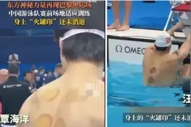 拔罐后的罐印都暗示啥？什么人不能拔火罐？来看→图片