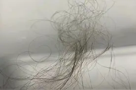 转发收藏！每天掉发超100根才算脱发图片