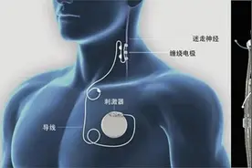 这项技术刚刚国产化，在湘雅三医院投入使用！难治性癫痫患者有了新选择图片