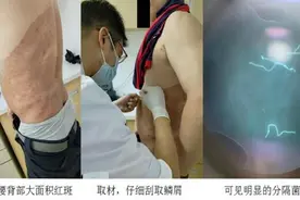 喜欢抠脚、血糖失控，男子患上体癣图片