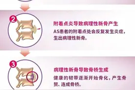 这种病好发于年轻人，18-35岁总出现腰酸背痛一定要重视！图片