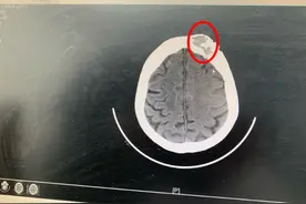 惊！福州女子额头长包，一查竟是瘤！骨头都被“吃”了……医生：这种病不能拖图片