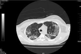 14岁女孩误服剧毒农药，全身多处渗血！送医急救31天后……图片