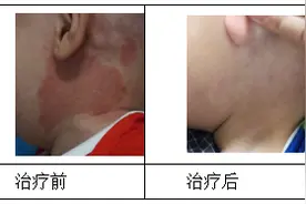 孩子患鲜红斑痣等不得，激光治疗越早越好图片