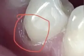 今天起，刷牙请务必调整一下！图片