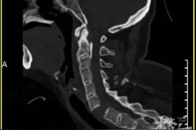 女子颈椎骨折导致全身瘫痪！仍在ICU抢救！这项活动近期热门，紧急提醒图片