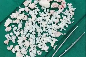 小伙关节密密麻麻长满“石头”！医生：都是这习惯害的，得改图片