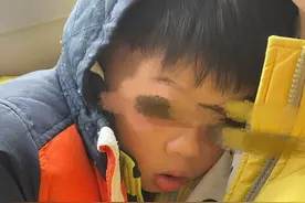 飞机上男孩突发过敏，眼睛肿成核桃，幸好同机中医师出手相助！图片
