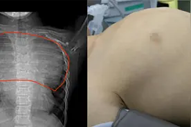 7岁男孩看似“鸡胸”实则隐藏1公斤重的肿瘤，在沪手术5小时切除图片