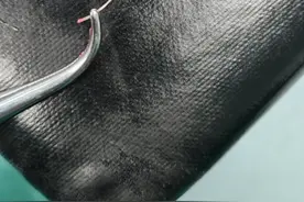 少女鱼刺卡喉1个月，险些保不住扁桃体图片