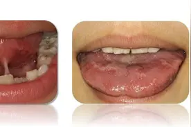 孩子吐字不清长大就好了？舌系带治疗这事可没这么简单图片