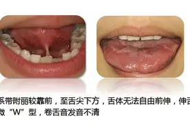 孩子吐字不清长大就好了？舌系带治疗这事可没这么简单图片