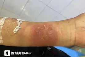 看到这种小土堆，千万别碰！已有人头晕、胸闷、全身发红图片