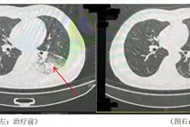 成都一男子吹空调致“白肺”，专家提醒警惕军团菌肺炎图片