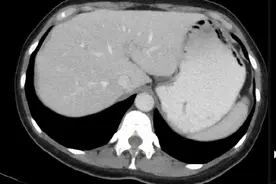 肠系膜滤泡性淋巴瘤图片
