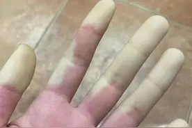 女生手指被冻白疑似雷诺现象，医生：该现象多见于20-40岁的女性，一定要及时就医图片