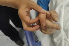 教科书式自救！老人被眼镜蛇咬伤，这样做捡回一命图片