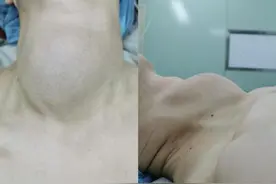 被鸡蛋大的肿瘤堵住气道，八旬老太呼吸困难，急需“拆弹”……图片