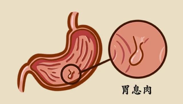 李雪琴自曝胃部切除8个息肉