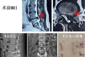 腰椎间盘突出术后复发怎么办？医生仅开4个微创小孔解决难题图片
