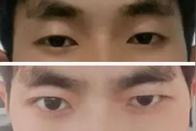 双眼皮术后变成“大小眼”，双方多次协商未果，院方拒绝接受采访图片