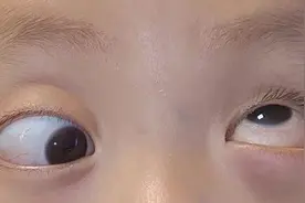 缺失眼外肌导致难以注视前方，罕见斜视患儿在沪治疗终能正常视物图片