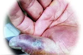 52岁杭州大伯洗小龙虾手指被刺伤，3天后多脏器衰竭离世图片