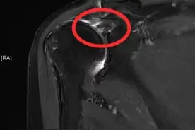 肩痛≠肩周炎，可能是肩袖损伤在“作祟”图片