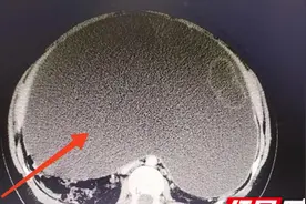 “发胖”四年竟是肿瘤作祟！专家提醒：异常肥胖需警惕隐匿疾病图片