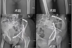 女子意外坠落，全身多处骨折，专家挑战骨科“天花板”手术精准复位图片