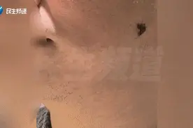 受伤后，男子意外发现脸上能吸住磁铁！医生都惊呼“从业20年第一次见”图片