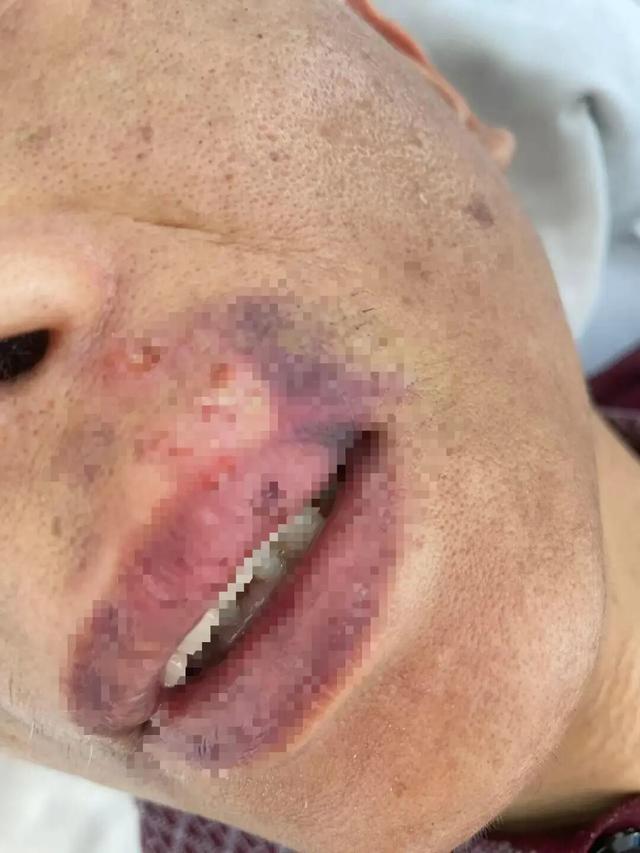 陕西一医院施工不合格，监理白天要求拆除整改，当晚被打断4根肋骨	，“工区突然断电，被3人打晕”，警方刑事立案