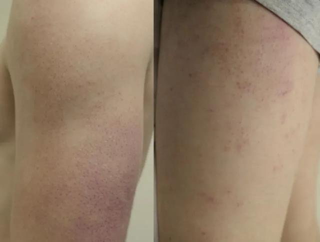 别抠了！这些小颗粒真不是痘痘，也别随便用药！