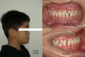 小小“兜齿”不害怕，早期矫正降服它图片
