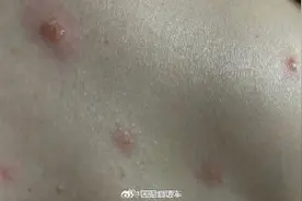 水痘传染性很强带状疱疹患者也可传染图片