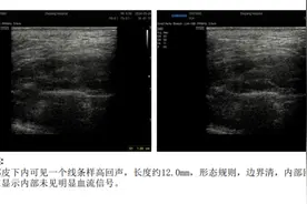 针头断进皮肤里，找不到了？杭州女子吓惨：再也不敢了图片