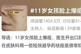 女孩脸上爆痘，医生开出避孕药图片