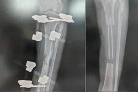 两年七刀，如锥刺骨，一招“移花接木”保肢成功图片