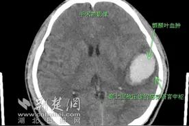 摔倒短暂昏迷后未重视 小伙险失语丢命 医生：摔倒头部要格外重视图片