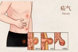疝气不治疗“拖”致肠坏死，医生警示：别把小病拖成大危机图片