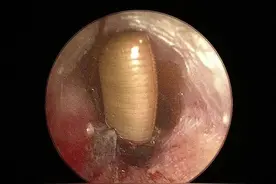 “快救救我！”女子睡觉耳内钻入一只……医生：千万别挖图片