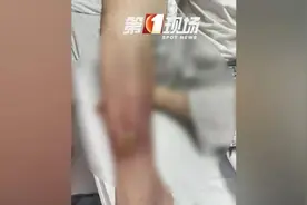 赶海、游泳要当心！一小伙游泳意外受伤，竟感染“丹毒”图片