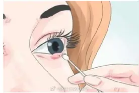 眼睑长了豆粒大小的硬核是怎么回事？图片