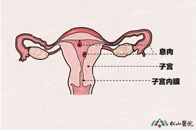子宫息肉能否自行消退 松山医院：仅部分！仍需排除高危因素图片