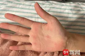 诊室病例|初中女生反复发热，原因竟是“蝴蝶病”图片