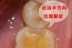 科普|完整的牙齿为什么咬东西会疼痛？图片