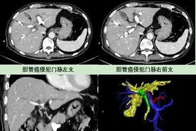 中国医科大学附属第一医院成功实施极限肝切除手术 肝门部胆管癌治疗取得新突破图片