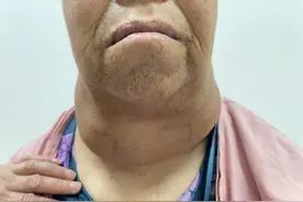 五十年甲状腺肿折磨终得解 北京友谊医院高难度手术为患者除病痛图片