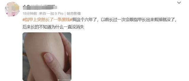 指甲出现这个变化可能是癌变