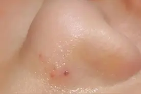 惊！两名小学生被“扎进” 急诊医生提醒图片